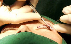 Là tiểu phẫu nhưng cắt mí hay bóc mỡ bọng mắt cũng có thể gây ra những hậu quả nhìn kinh khủng như thế này