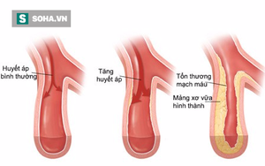 Cứ 4 người lại có 1 người tăng nguy cơ đột tử do căn bệnh ai cũng có thể mắc phải này