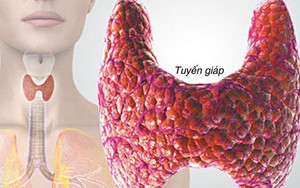 20 triệu người Mỹ mắc bệnh tuyến giáp: Hiểu rõ suy giáp, cường giáp và ung thư tuyến giáp