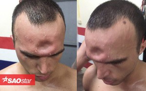 Võ sĩ Muay Thái lõm trán vì dính cú đòn cùi chỏ tàn khốc của đối thủ