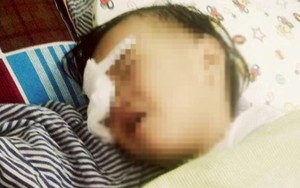 Nghệ An: Xót xa bé gái 2 tuổi bị gà chọi mổ mù một mắt