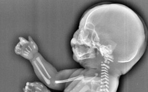 Dù thai đã được 6 tháng, bà mẹ vẫn quyết định bỏ con khi xem hình siêu âm gây sốc này