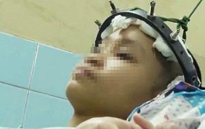 TP.HCM: Cột sống ngực vẹo 111 độ, lưng bé gái 12 tuổi cong như hình chữ S