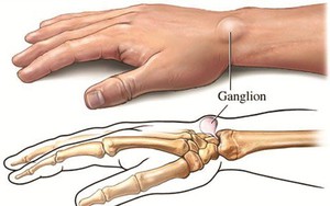 Khi bị nổi cục u không đau, đừng tự 'đoán' lành hay ác, khám chậm trễ có thể thành tật