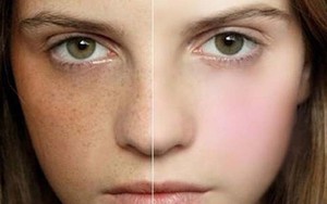 Thâm nám da khi mang bầu: Làm sao để tránh?
