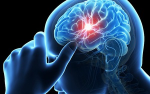 Đau đầu có thể là dấu hiệu căn bệnh gây tử vong nhanh đe doạ nhiều người trẻ