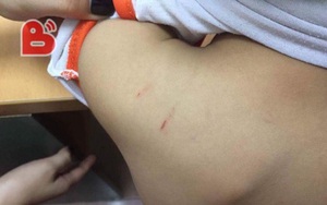 Hà Nội: Xôn xao việc giáo viên mầm non đánh con riêng của chồng thâm tím cơ thể