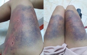 Hà Nội: Một phụ nữ tố bị bạn trai đánh thâm tím khắp cơ thể
