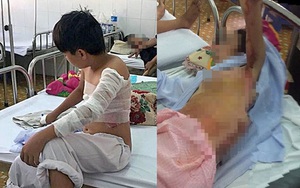 Lao vào cứu mẹ đang bốc cháy, thiếu niên 15 tuổi bị bỏng nặng