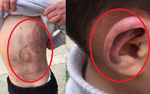 Bé trai 6 tuổi bị bố đánh bầm dập, phải ngủ dưới gầm ô tô vì không dám về nhà