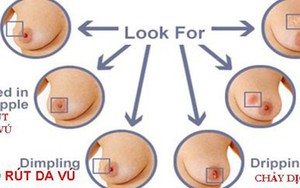 Bác sĩ bệnh viện Từ Dũ chỉ 7 dấu hiệu nếu có cần đi khám ung thư vú ngay