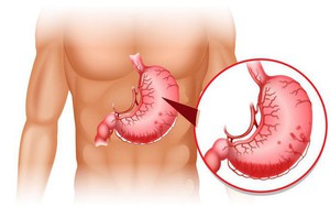 Viêm dạ dày lâu ngày có thể dẫn tới ung thư: Phát hiện và chữa kịp thời nhờ 8 dấu hiệu