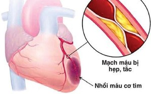 Chữa đúng cách, bệnh nhân thiếu máu cơ tim vẫn có thể sống khỏe mạnh