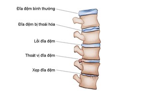 Chuyện bệnh nhân lâu năm chữa trị thoái hóa cột sống hiệu quả