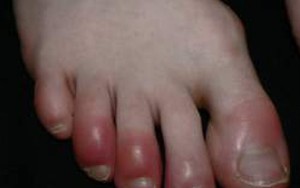 Những bài thuốc dân gian trị cước chân