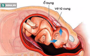 Sản phụ Hà Nội vỡ tử cung suýt tử vong: Chuyên gia khuyến cáo tai biến sản khoa nguy hiểm