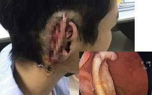 Công an vào cuộc vụ nam sinh cắn đứt tai bạn rồi nuốt luôn vào bụng