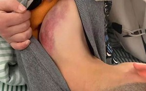 Đi trễ 2 phút, cậu bé bị giáo viên đánh bằng 4 cây chổi, nhìn ảnh thương tích cư dân mạng tức giận phán "không phải con người"