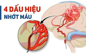 BS cảnh báo: 4 dấu hiệu cho thấy mạch máu đang dần bị tắc, xử lý ngay để tránh nguy hiểm