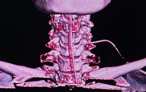 Vừa ăn vừa nói chuyện, cụ bà bị xương cá đâm xuyên từ thực quản ra cổ