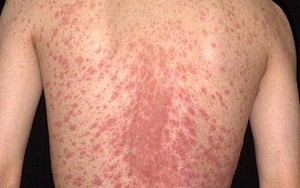 Hỗ trợ điều trị vẩy nến hiệu quả: Cần kết hợp “trong uống, ngoài bôi”