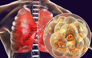 Trời lạnh rất dễ viêm phổi: 8 dấu hiệu "tố cáo" bệnh sớm biết để ngừa biến chứng nguy hiểm