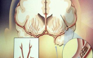 Trà thuốc cho người tăng huyết áp