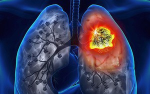 BS bày cách phân biệt triệu chứng ho để phát hiện ung thư sớm: Người hút thuốc cần chú ý