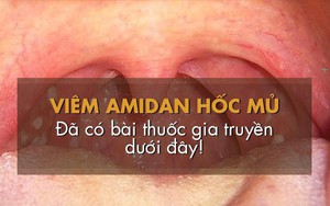 Bệnh viêm amidan hốc mủ: Dấu hiệu và cách chữa hiệu quả