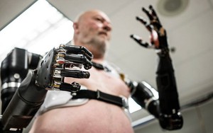 Người đàn ông đầu tiên trên thế giới sống với cánh tay robot điều khiển bằng trí não