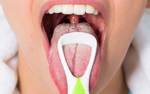 Khi thấy dấu hiệu này trên lưỡi, hãy cẩn thận với bệnh dạ dày và khẩn trương đi khám