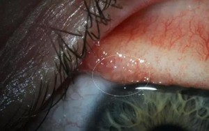 Phát hiện giun lạ sống trong mắt người