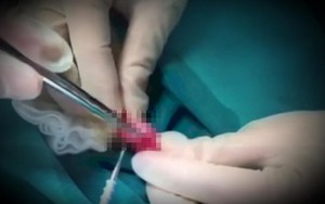 Tiểu phẫu sùi mào gà hết 70 triệu, bệnh nhân tố phòng khám có bác sĩ Trung Quốc "chặt chém"