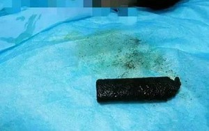 Bác sĩ lấy ra chiếc bật lửa bệnh nhân đã nuốt 20 năm trước, kết quả sẽ khiến bạn thực sự rùng mình