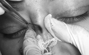 Cô gái 22 tuổi ở Bạc Liêu bị hủy hoại dung nhan vì đi nâng mũi bằng chỉ