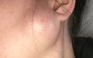 Phát hiện vết sưng nhỏ trên mặt trước khi sinh, người mẹ trẻ đâu ngờ sau 2 tuần lại trở thành khối u ác tính và cô mắc bệnh ung thư giai đoạn cuối