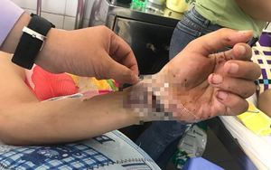 Nối liền bàn tay cho một nam bệnh nhân sau nhiều giờ bị chém đứt lìa