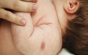 Đắp khoai tây, lòng trắng trứng gà giảm sưng tấy sau tiêm?
