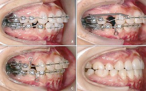 Chân răng lệch ra ngoài ổ xương vì niềng răng
