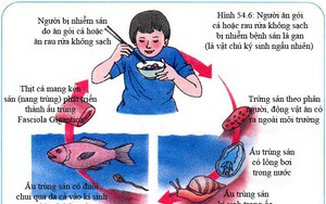 Lấy 800 con sán từ ống mật của người hay ăn gỏi cá