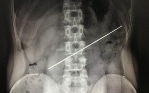 Nuốt thanh thép gần 20 cm vì cá cược 18 triệu đồng và cái giá đắt