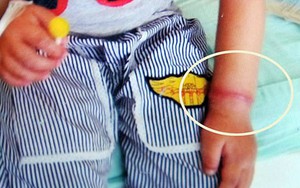 Người lớn không để ý, bé gái suýt mất một bên tay vì vật dụng nhỏ xíu nhà nào cũng có