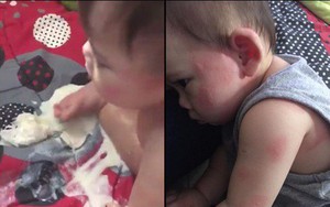 Cậu bé bị nổi ban đỏ, nôn mửa và tiêu chảy nghiêm trọng do uống sữa công thức giả