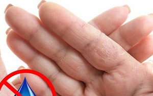 Dấu hiệu bàn tay cho thấy các vấn đề về sức khỏe của bạn