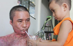 Bị điện giật cháy người không có tiền chạy chữa, bố xót xa nhìn con trai 4 tuổi không nhận ra mình