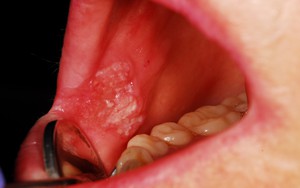 [PHOTO STORY] Đừng nhầm lẫn với bệnh ở miệng, đây là những dấu hiệu cảnh báo ung thư mà bạn nên nhớ