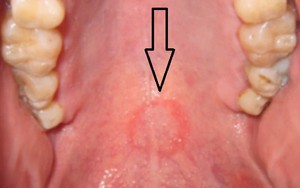 Do oral sex quá nhiều, vòm miệng của người đàn ông xuất hiện một dấu hiệu lạ