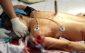 Bệnh viện bật 'báo động đỏ' cứu người đàn ông bị dao đâm xuyên ngực