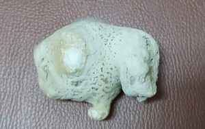 Phát hiện sỏi có kích thước lớn trong người đàn ông bị thận móng ngựa