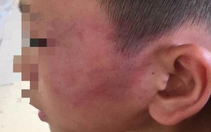 Nghệ An: Nghi án bé trai 12 tuổi bị mẹ kế đánh thương tích đầy mình phải nhập viện